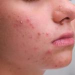 Muncul Jerawat